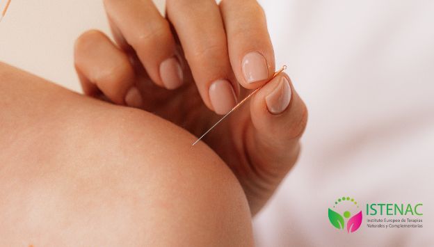 acupuntura-para-tendinitis-de-hombro-UM